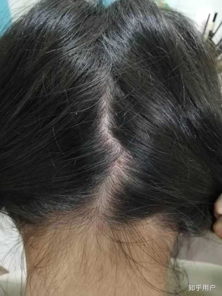 头皮上老是长痘痘,扣了是个血痂要不然就是按着疼的包