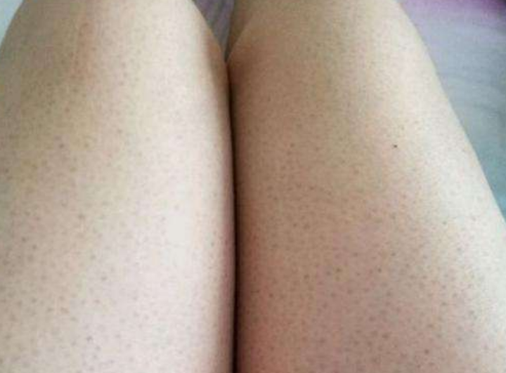大家是如何看待鸡皮肤这个问题的?