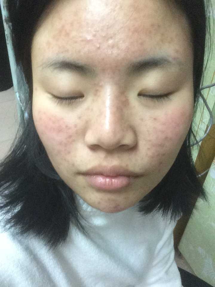脂溢性皮炎和玫瑰痤疮能治好吗,恢复到一般人程度?