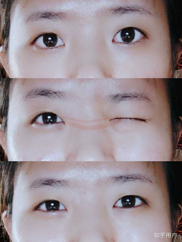 怎么从单眼皮自然变成双眼皮?