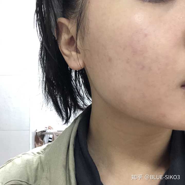 激素脸形成严重的痘印和黑色素,用什么方法可以去除掉?