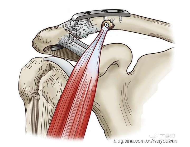 肩锁关节一级脱位,骨头突出还能回复到正常状态吗?
