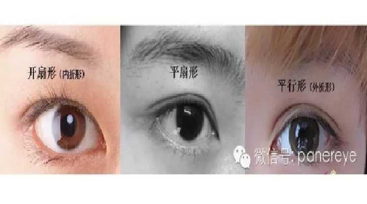 准备去做埋线想问问我这种眼睛适合平行还是开扇我眼睛算不算内眦赘皮