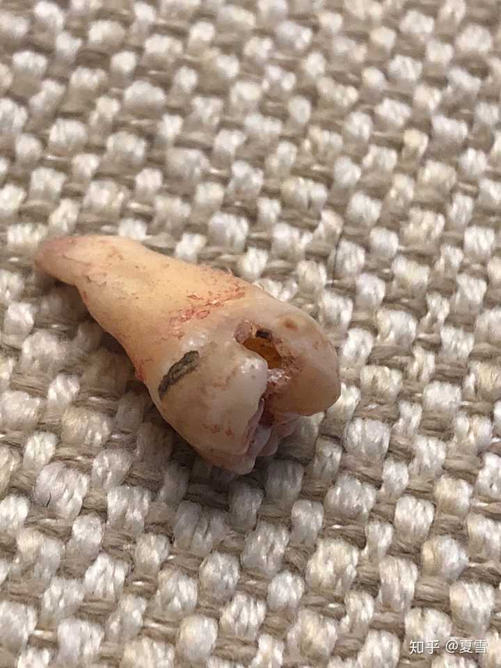 接下来说一下到底有没有刷干净蛀牙,刚刚拔牙前医生已经简单清理过