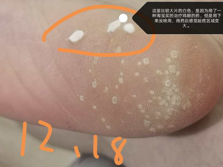 跖疣的自愈性大吗?