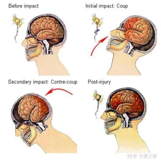 人的脑袋剧烈晃动的时候脑子为什么不会变成一团浆糊?