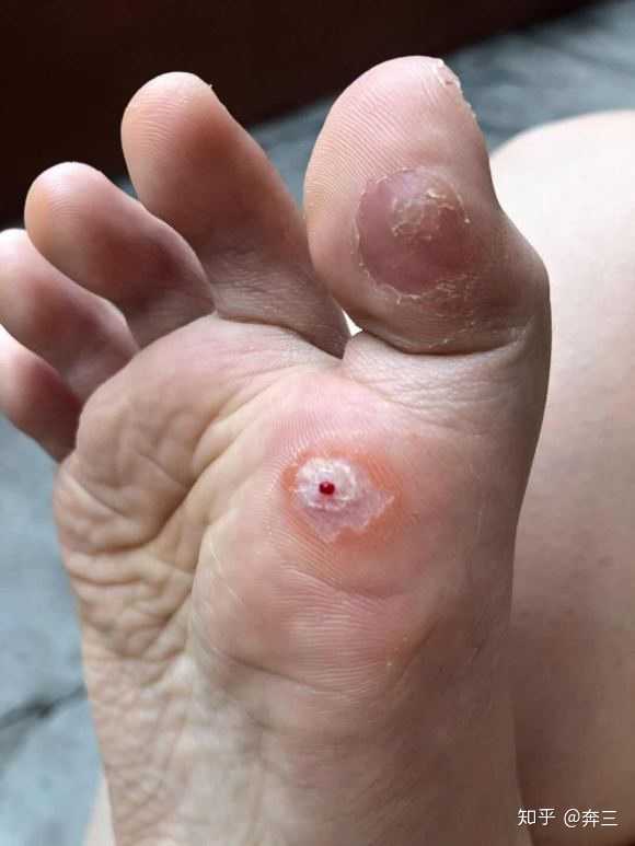 刚长出来的小跖疣怎么治?