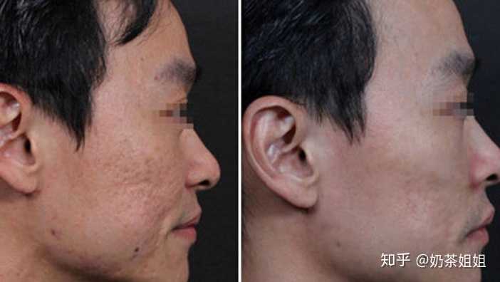 至少是可以把脸部的坑坑洼洼修复的,皮肤不会这么凹凸不平 这是点阵