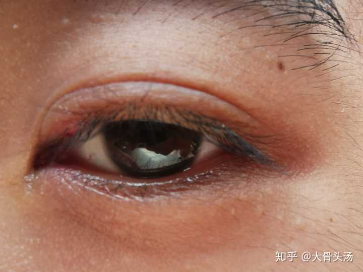 就是在下方麦粒肿好的差不多的时候,突然上方又冒出来一个(是的都是