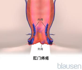 痣是位于直肠和肛门壁的曲张静脉. 压力增加导致静脉曲张.