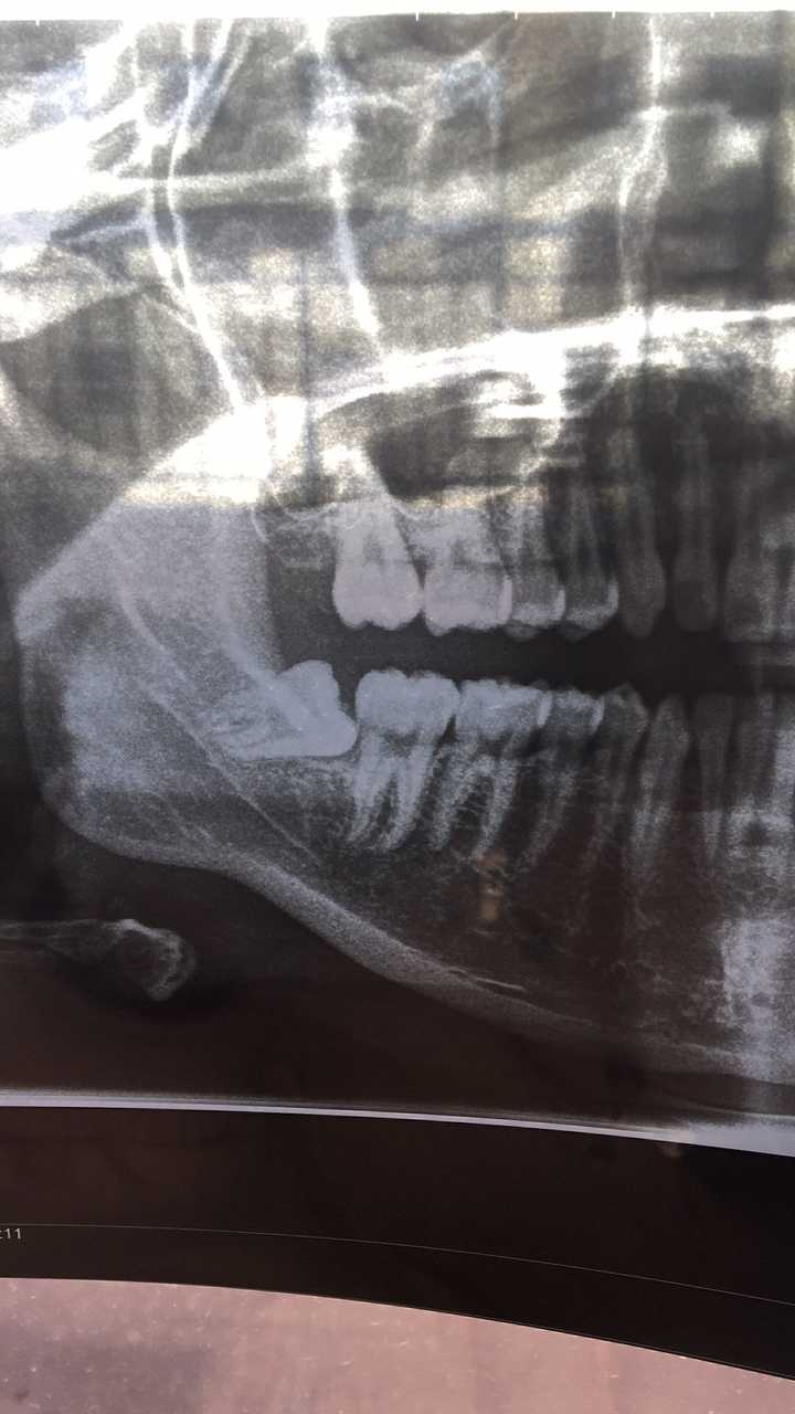 拔智齿有多痛?