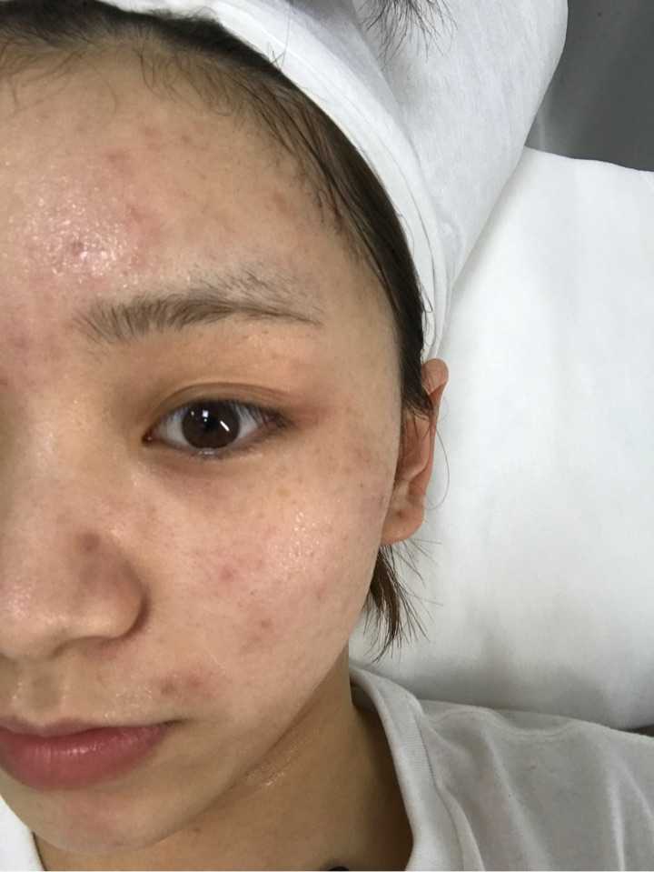 谁做过光子嫩肤,有效果吗?