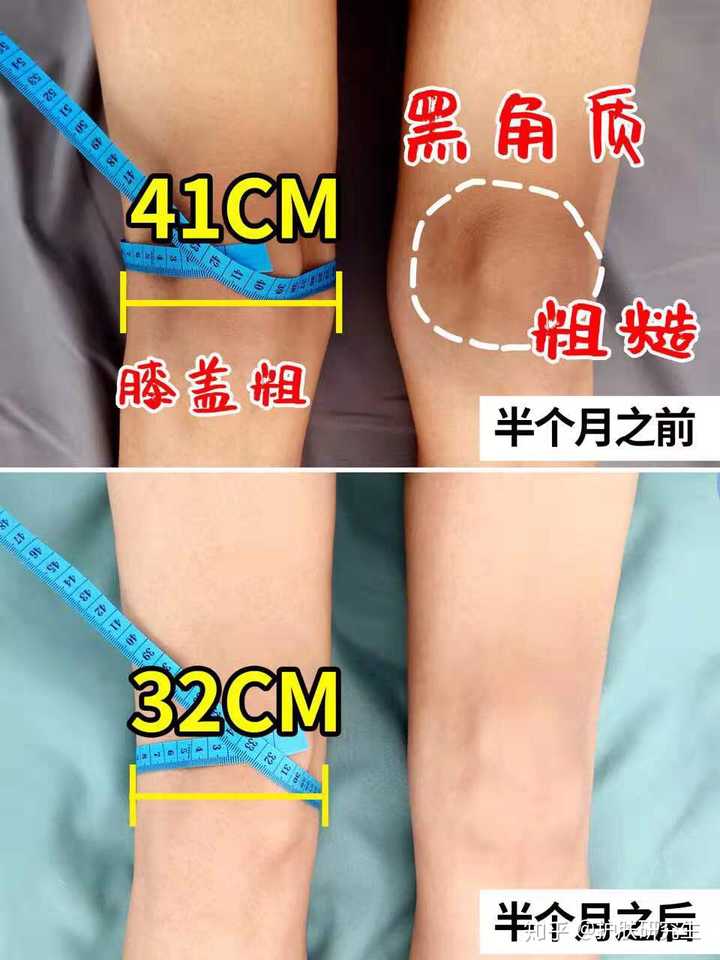 膝盖很黑是为什么?有什么办法吗?
