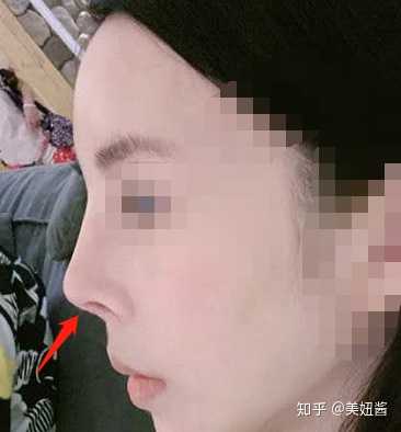 像沈梦辰和车晓 就是属于被l型假体的残害的,还没等老了,鼻子就需要