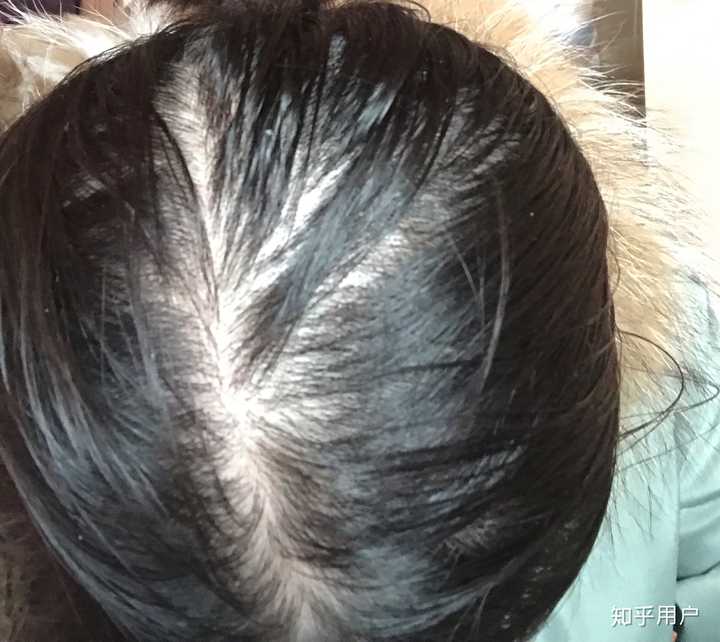 女生秃顶是怎样一种体验?