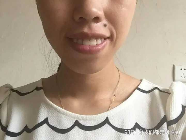 戴牙套值得吗?
