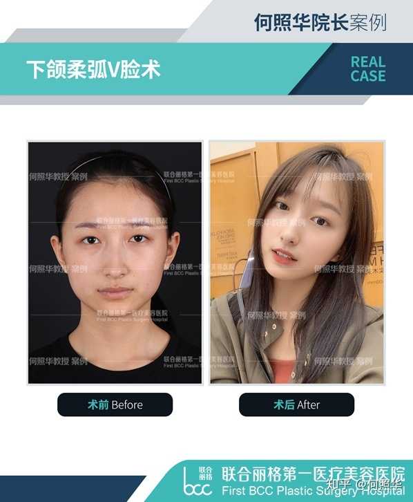 这样的咬肌是不是只有削骨了