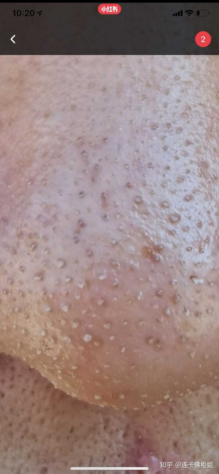 挤黑头有多爽?