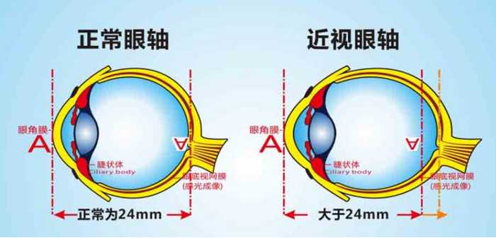 正常眼轴和近视眼轴的眼球对比示意图