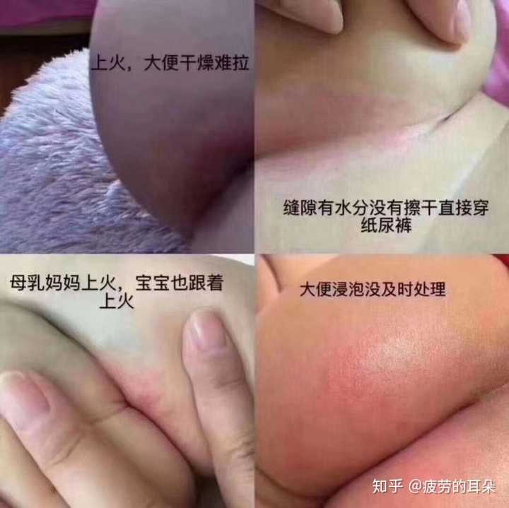 宝宝屁屁红,是不是应该换个纸尿裤?