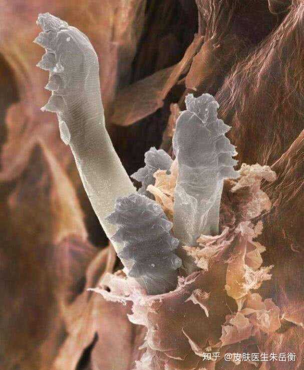 这种人蠕形螨俗称毛囊虫,寄生在人体的毛囊虫引起的慢性炎症叫蠕形螨