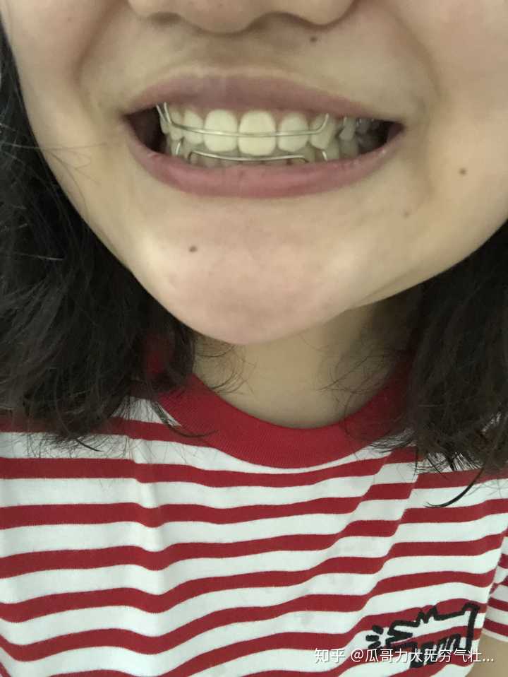请问牙齿保持器哪一种效果更好,更加牢固?