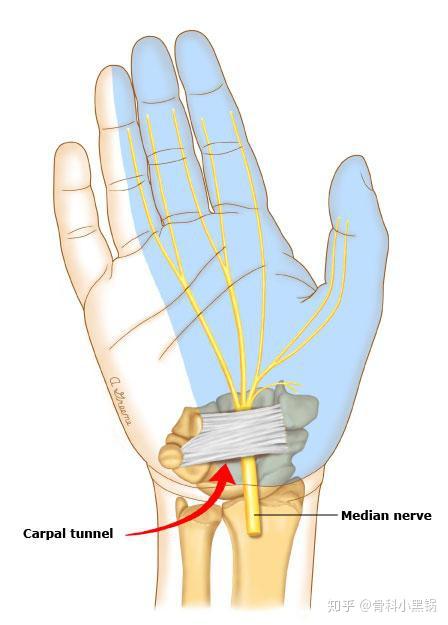 腕管综合征和手部腱鞘炎的区别是什么?
