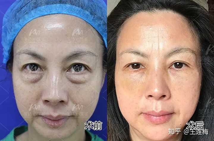 双层眼袋严重怎么办,附图,希望大半夜不要吓到大家?