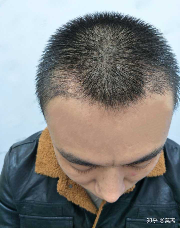 如果是非正规的,植发效果不敢保证,甚至还有失败的风险