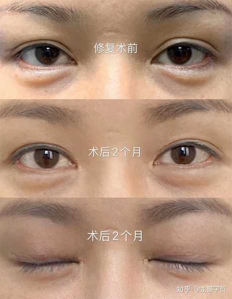 双眼皮做的很好的医生,也擅长修复吗?