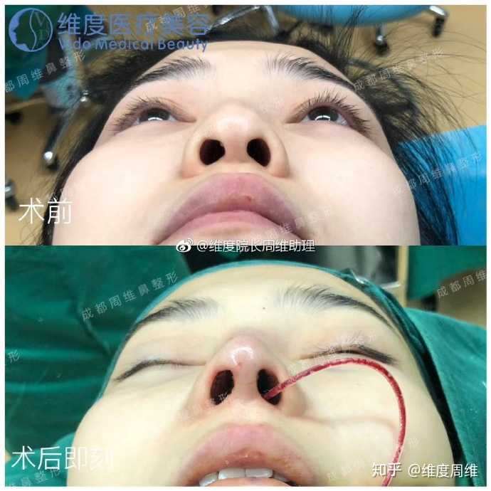 隆鼻手术增生疤痕软化针多久能打?