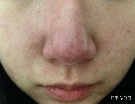 酒糟鼻是一种发生于鼻部的慢性,炎症性皮肤病,主要表现为红斑,丘疹