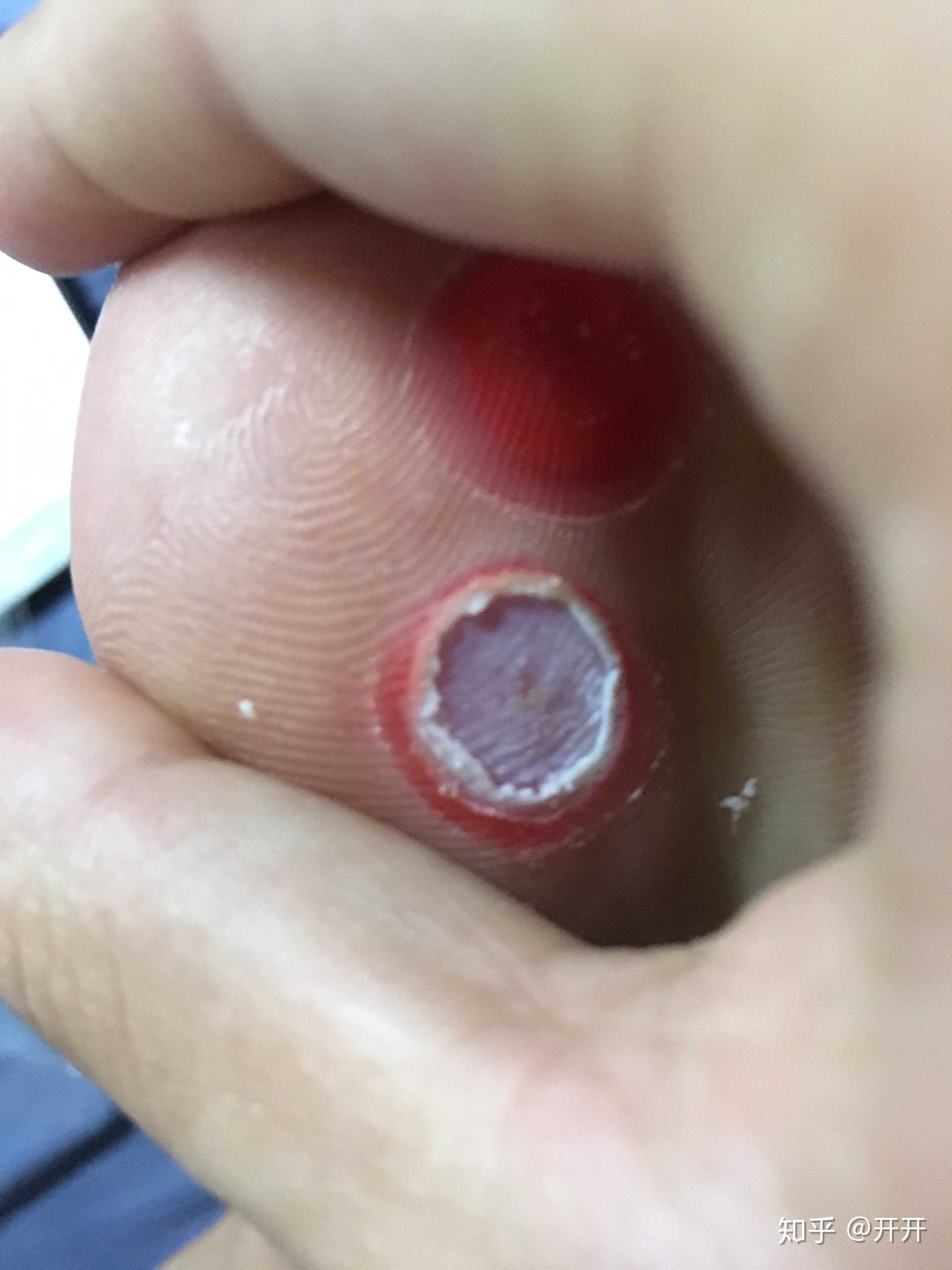 鸡眼贴使用过程
