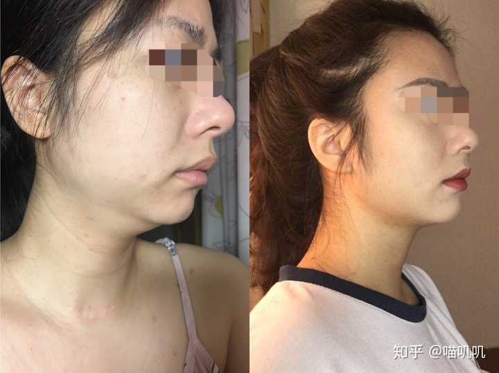 双下巴非常严重 怎么办?