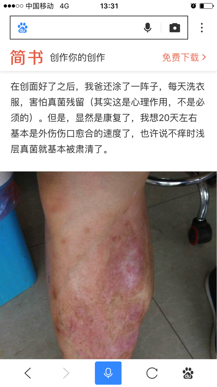 结节性痒疹如何治疗?哪里就医比较好?求大神指点!