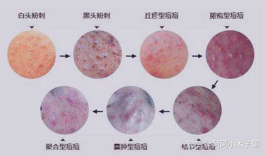 我脸上的闭口痘印该怎么办红色的痘印三年了都没消还有救吗