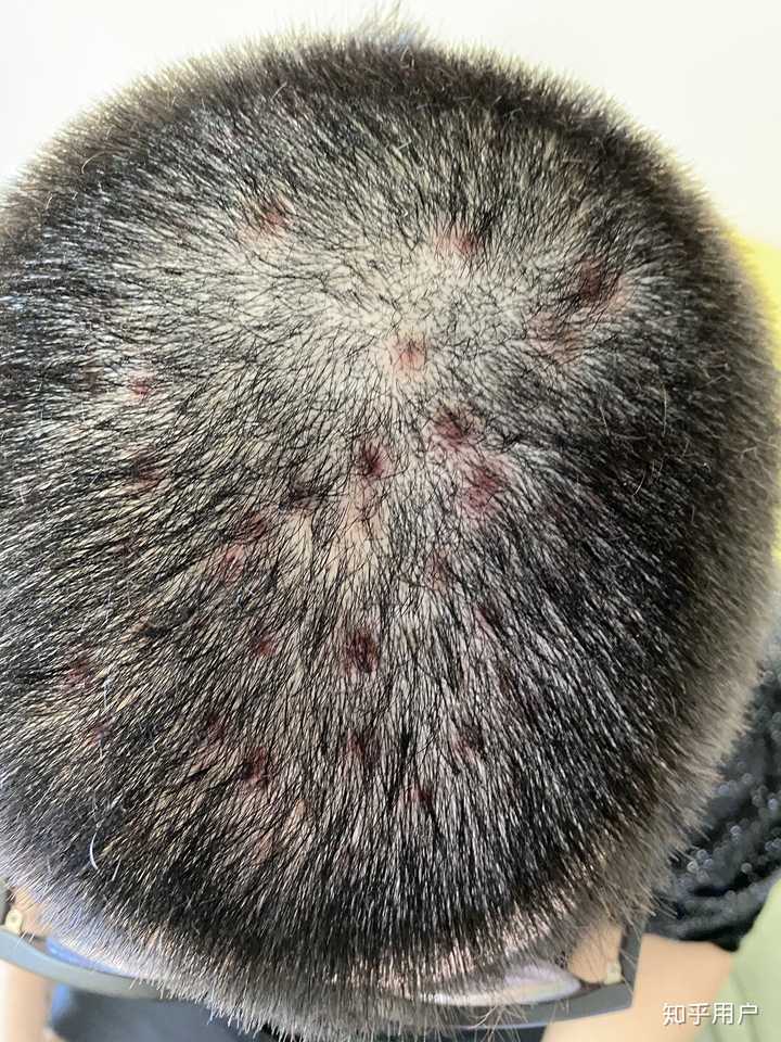 见过的最大头皮屑多大?