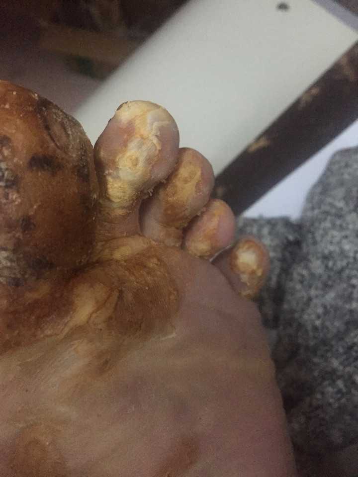 跖疣如何治疗?