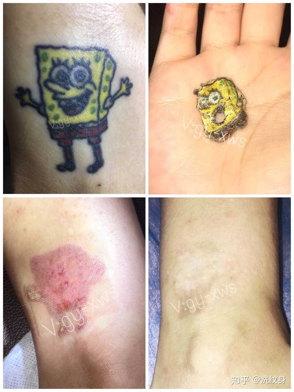纹身色素洗干净后新皮肤是红红的.