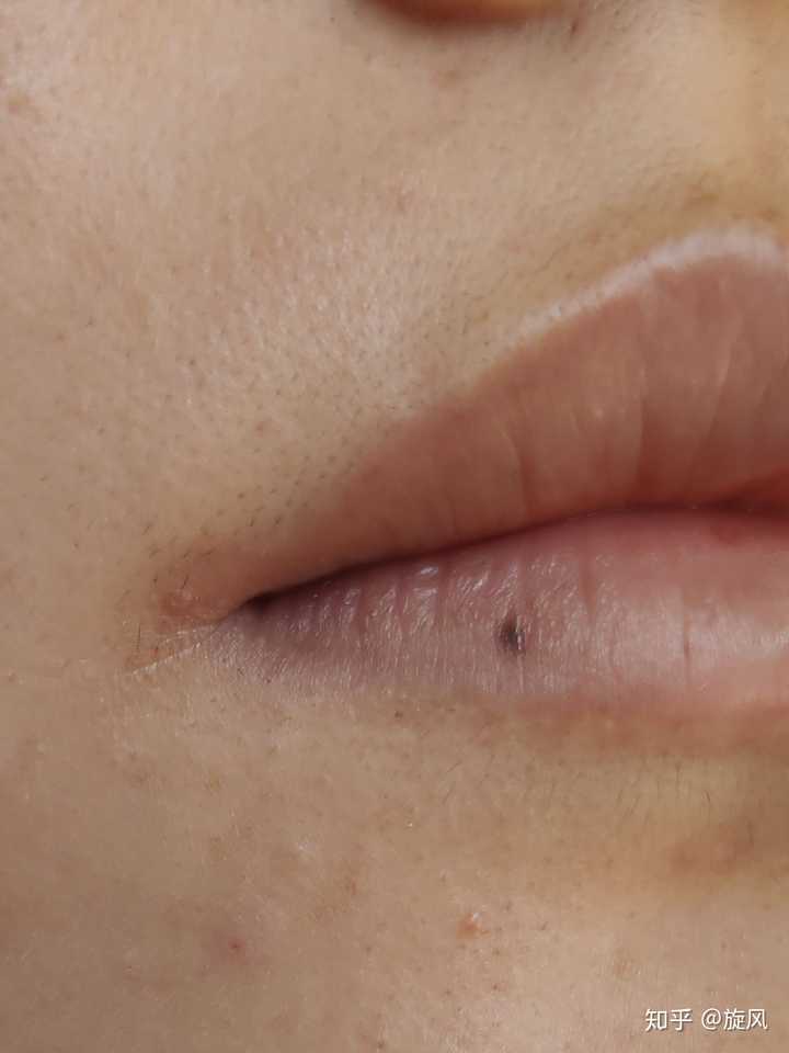 冰点脱毛仪脱唇毛效果如何?