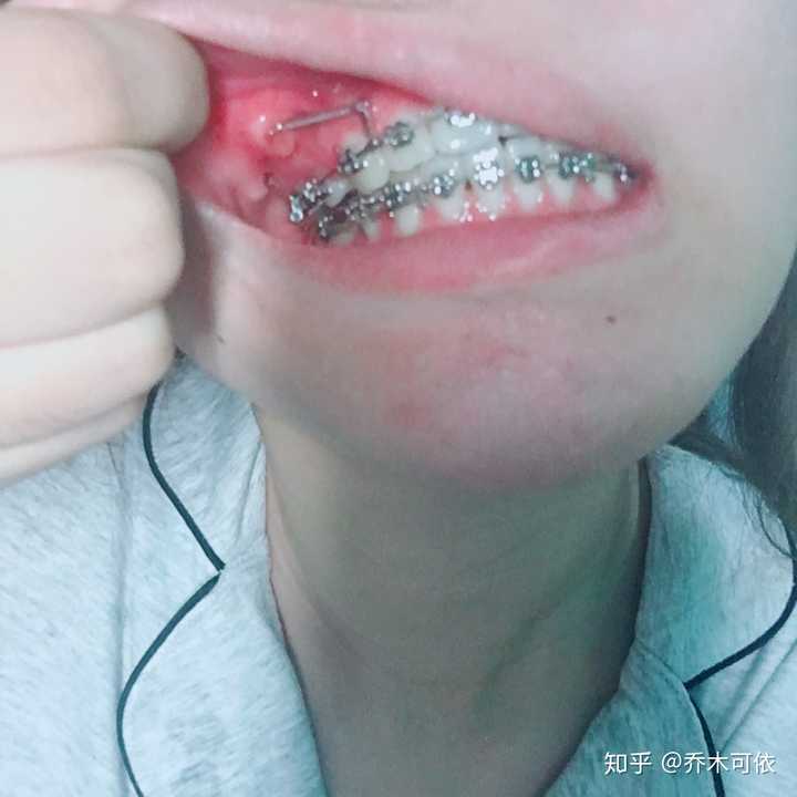 女生矫正牙齿后变美是怎样的体验?