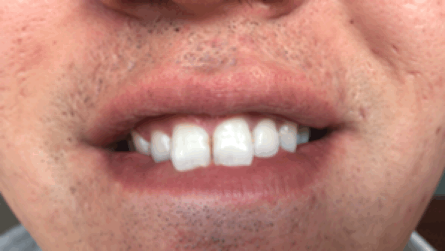 唯爱牙齿美白冷光仪真的有效吗?