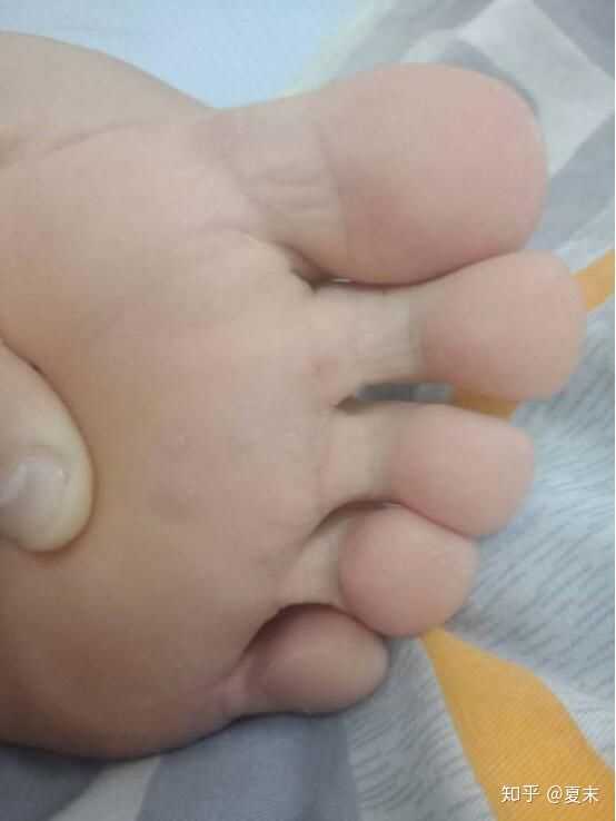 脚上这样茧子怎么治啊?