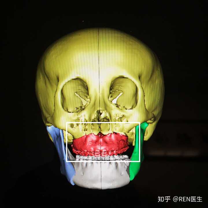 正颌手术可以弥补上下颌骨发育不足的问题吗?