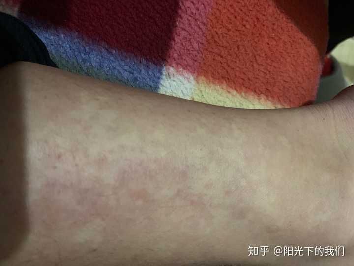 腿上长斑,怎样变消失啊?