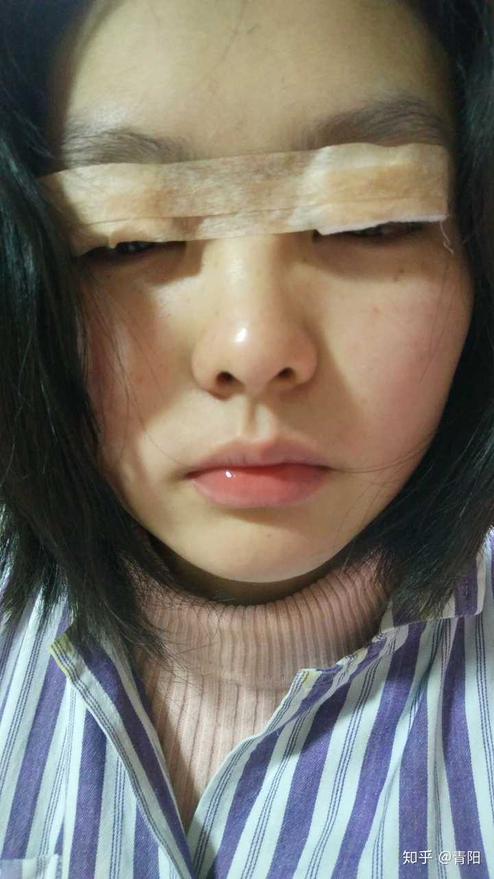 昨天刚割完的时候 纱布压的我完全看不清路 高度近视的我宛如一个瞎子