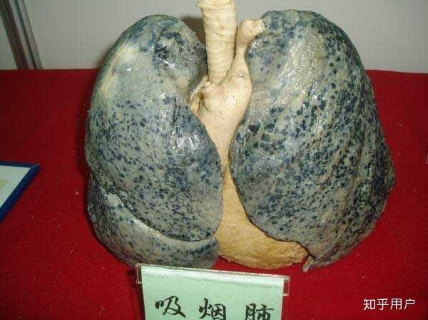 这就是一个烟民的肺,布满青绿色的斑点,看上去狰狞又恶心.