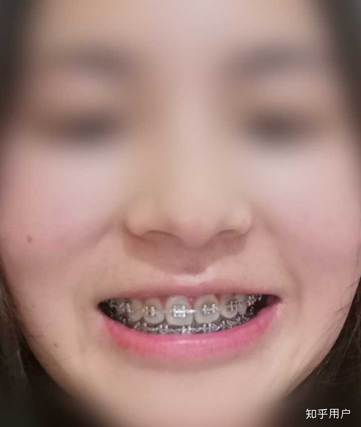 马上摘牙套了,感觉上排牙齿不对称,且有点往外飘,医生非说很整齐,是我