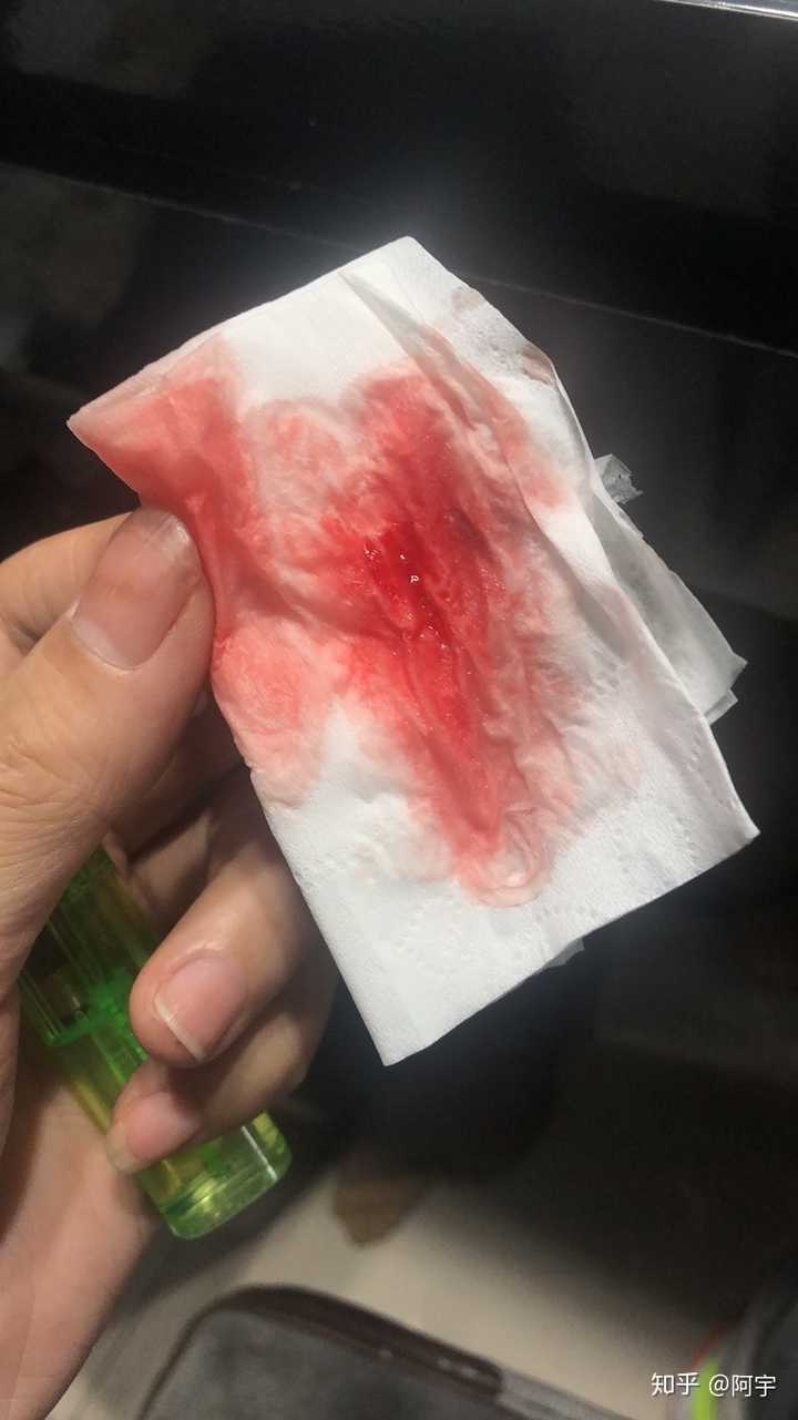 拔完智齿后一直流血正常嘛?