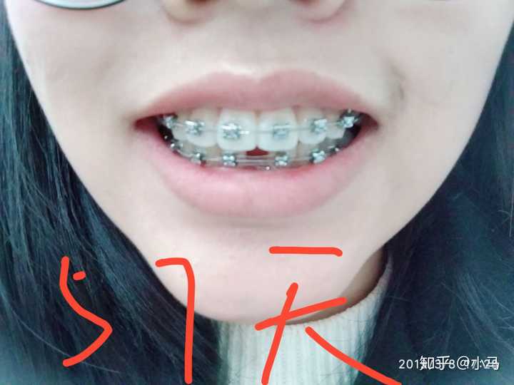 矫正牙齿前后对比图很惊艳是一种怎样的体验?
